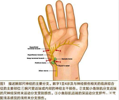 guyon 氏综合征(guyon"s syndrome)又叫腕尺管综合征(carpal ulnar