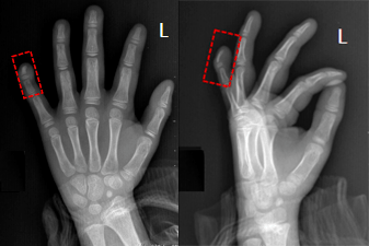 case 2多指畸形及融合畸形.case 1如果你也有此类收