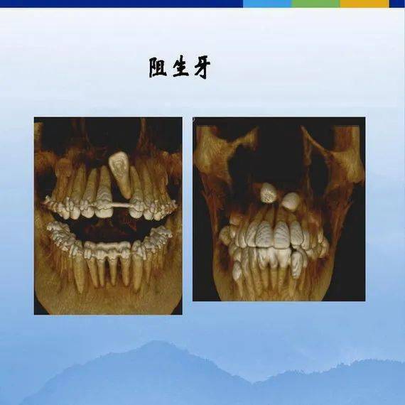 牙体牙周正常解剖及常见病x线表现