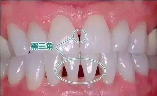 相邻牙齿外形最突点虽然接触在一起,可是相邻牙齿之间的牙龈并不能