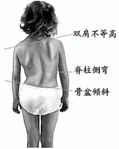 父母|12岁女孩弯腰时，父母发现不对劲！每10个孩子就有2个中招！