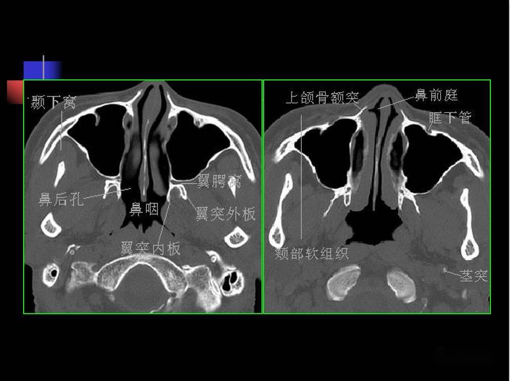 收藏必备鼻咽部的ct详细解剖