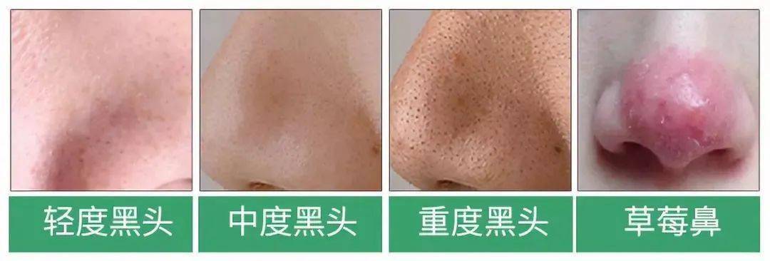 毛孔|原来想要拥有干净、清透的“初恋素颜脸”，只需要做好这一步！