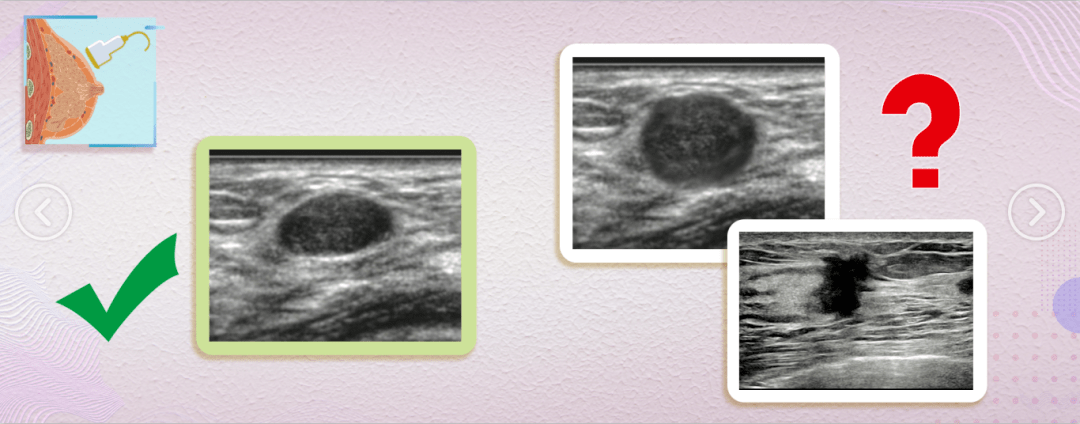 恶性的乳腺结节有这3种表现,一旦发现,千万别大意!