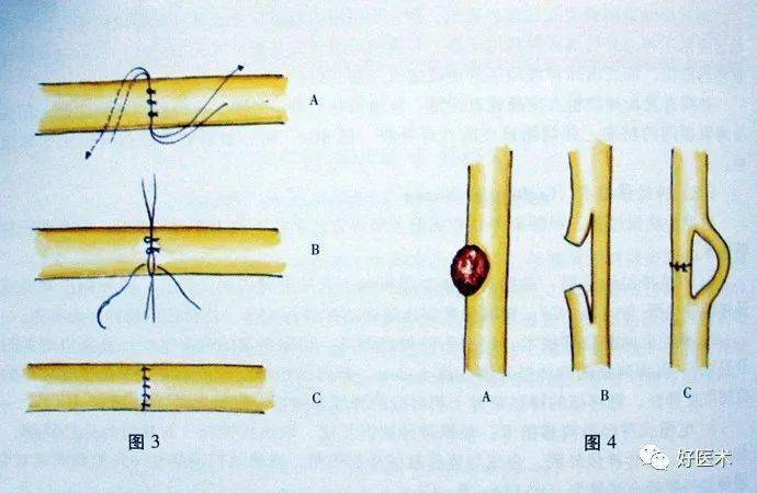 3)神经修复手术方式 神经缝合术 ①对接:外膜(鞘膜)法,束膜法 ②端