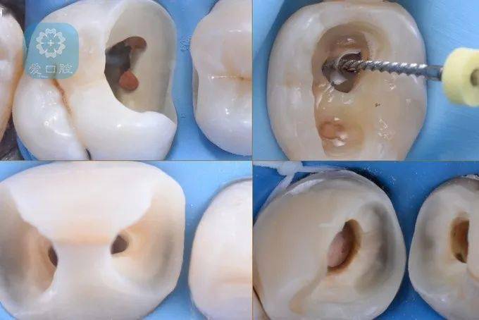 【牙医干货】根管治疗后牙齿的微创修复!