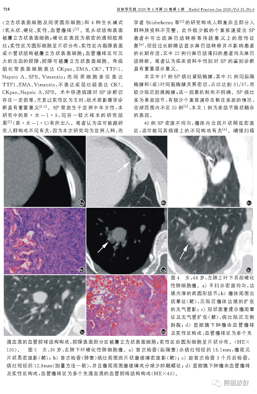 硬化性肺细胞瘤丨msct特征