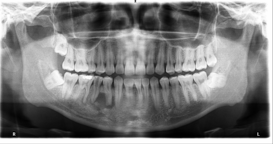 诊断: 44牙,45牙根尖囊肿 治疗计划:1,44,45牙根管治疗 冠修复 2