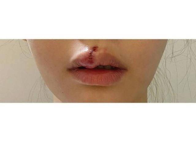 香港人气女歌手被流浪狗咬到满脸是血,嘴巴缝了9针,担心破相