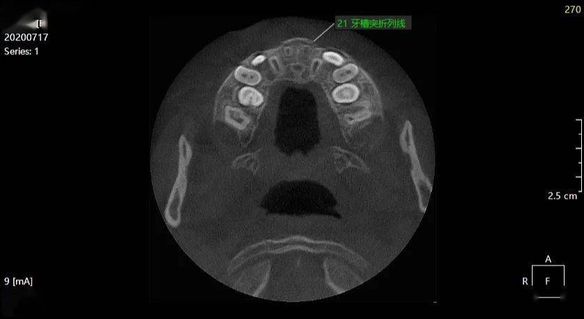 刘xx 20200717 前牙外伤cbct 180xxxx9667_牙根