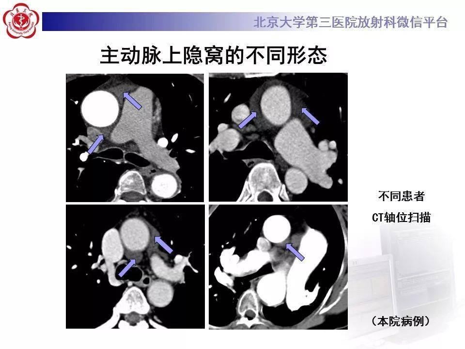 影像精美解剖丨心包窦及心包隐窝解剖建议收藏