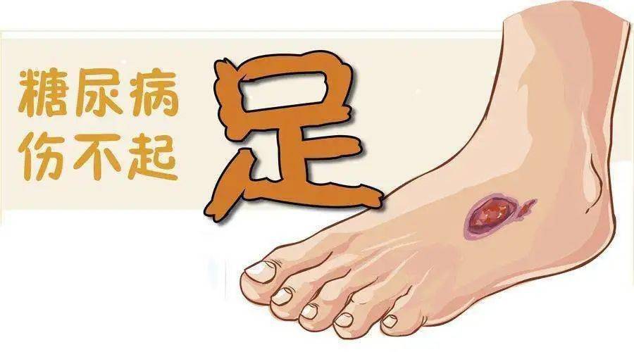 足部|脚上出现这几种异常，说明血糖已超标！