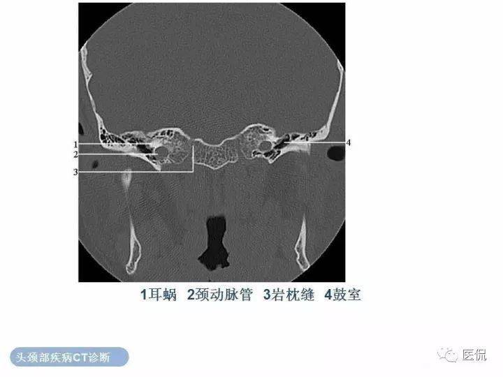 经典收藏最全颞骨详细ct解剖