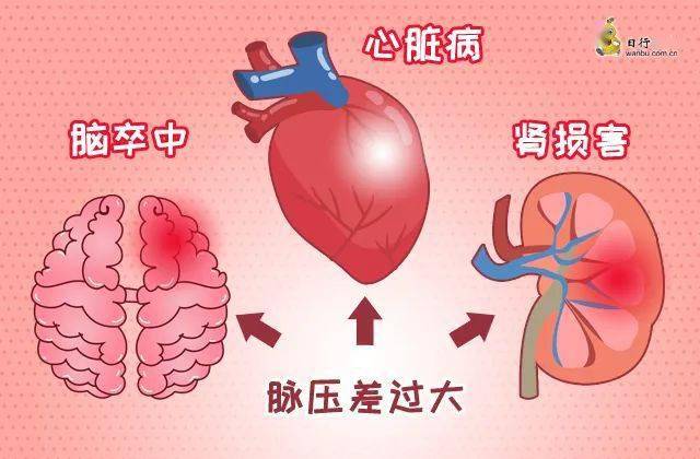 高血压管理(六|高压减去低压差值太大,这可不是好事!_脉压