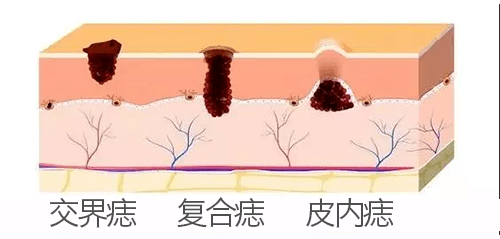 科普—同为有"痣"之士,你了解你的痣吗?