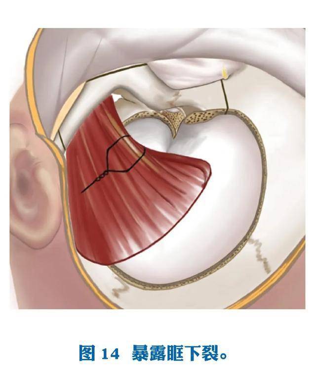 神经外科手术绘图之眶颧入路