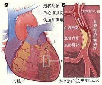 真有"心碎综合症"吗?