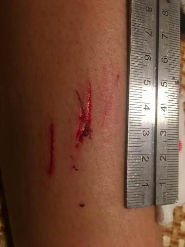 小陈|险！精装房浴室玻璃门炸裂 19岁女孩身上多处被扎伤