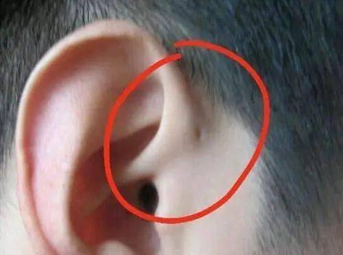 先天性耳前瘘管是位于耳轮前方和耳屏上方的小凹陷,大部分先天性耳前