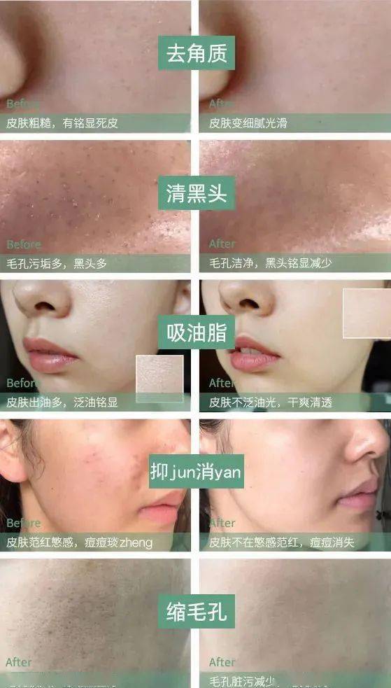 吸铁石|新西兰百年历史“污垢吸铁石”,15分钟告别黑头、粉刺、闭口!