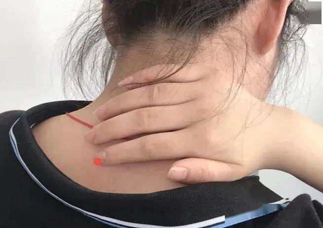 简单的说,是在颈胸结合部(颈7和胸1)的位置,鼓出一个大包