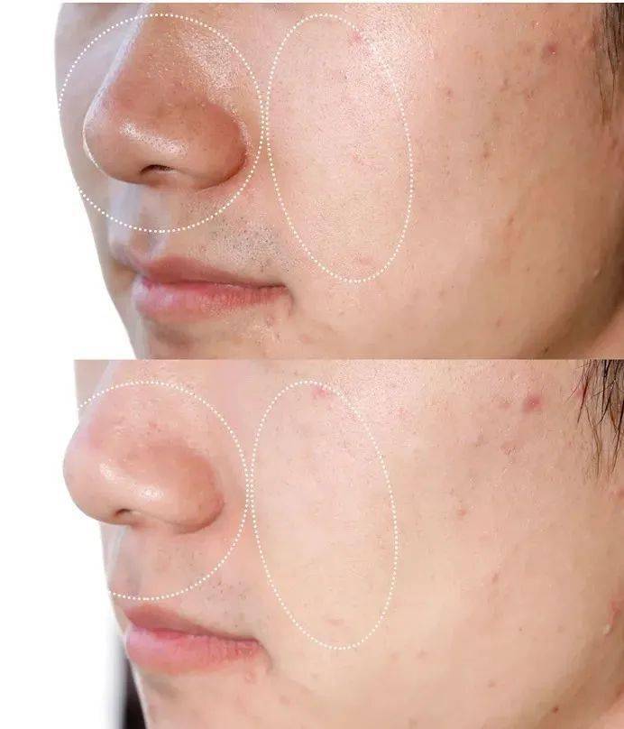 吸铁石|新西兰百年历史“污垢吸铁石”,15分钟告别黑头、粉刺、闭口!