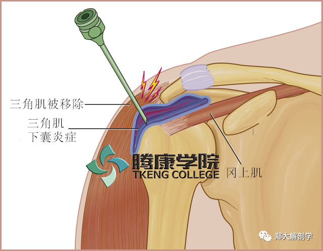 疼痛解剖学|三角肌下滑囊