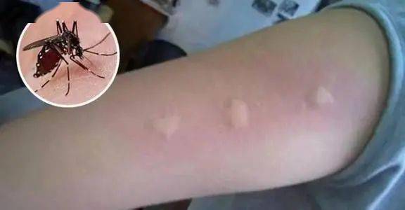 也叫丘疹性荨麻疹,它是一种过敏性疾病,大多是因为受到蚊虫的叮咬后