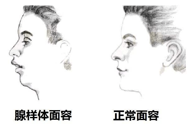 形成所谓的"腺样体面容"等症状.