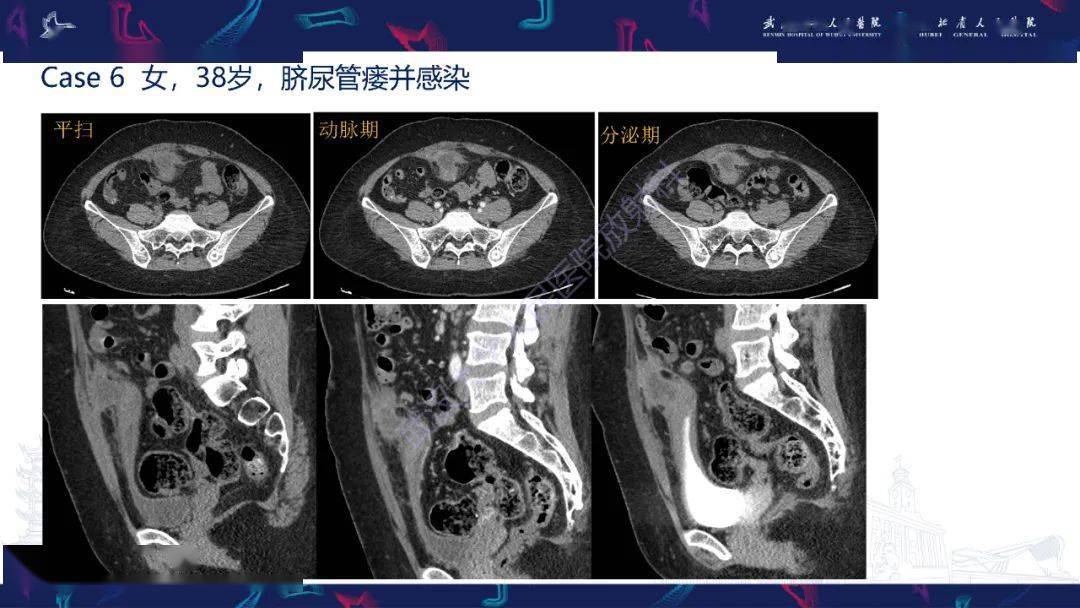 实例解析脐尿管病变影像诊断