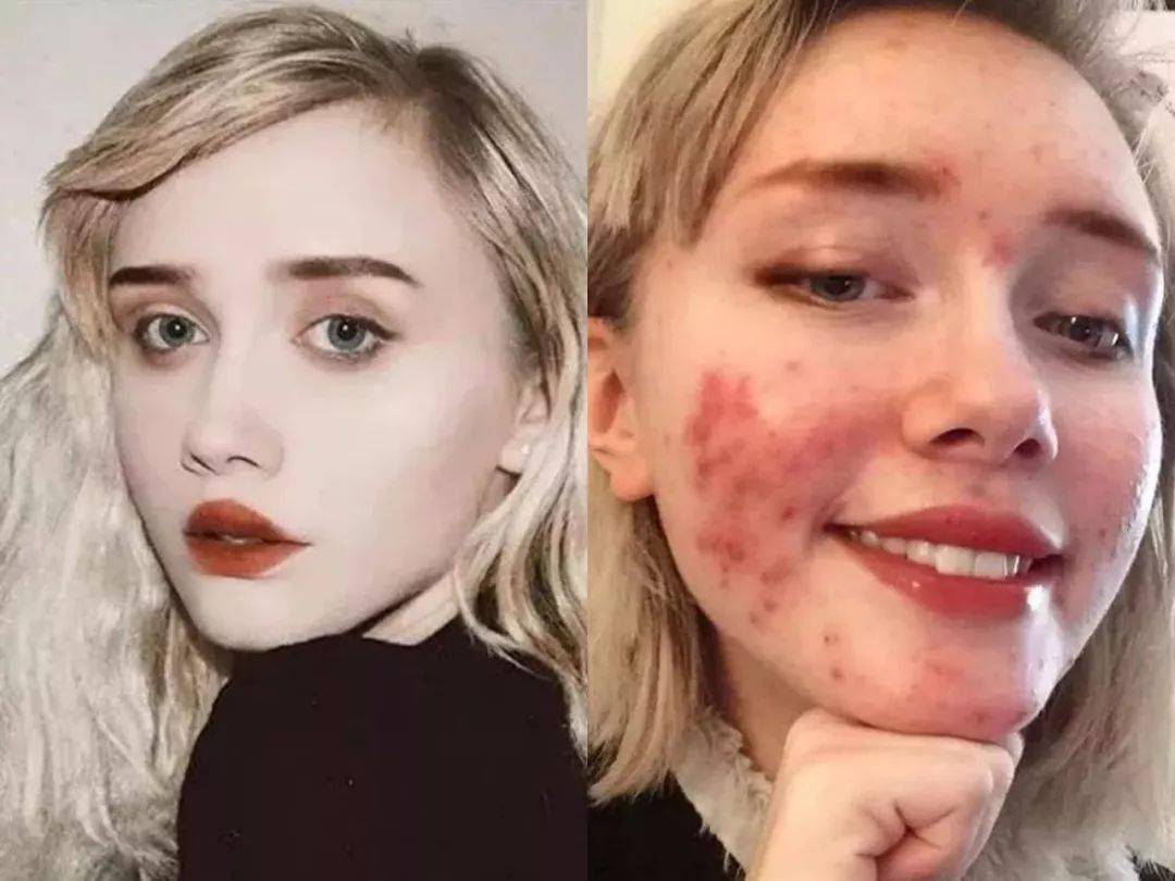 祛痘|30秒get医美“刷酸” ，从此和痘痘大毛孔形同陌路！