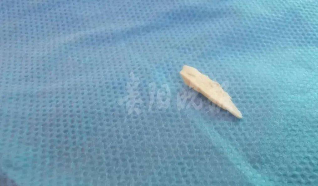 硬币|医生都无语！孩子竟吞下这些怪东西！硬币、指甲刀、电池、钉子……