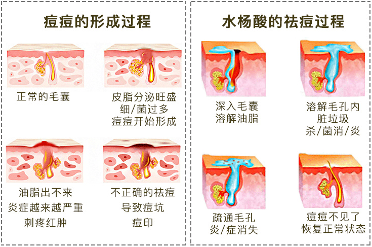祛痘|30秒get医美“刷酸” ，从此和痘痘大毛孔形同陌路！