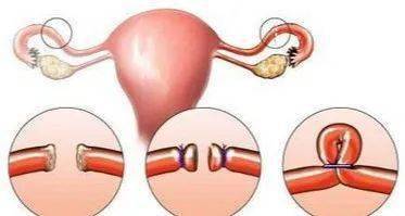 怎么样上环 195e83c4ec6f429188bcffedb38f4e6c.jpeg