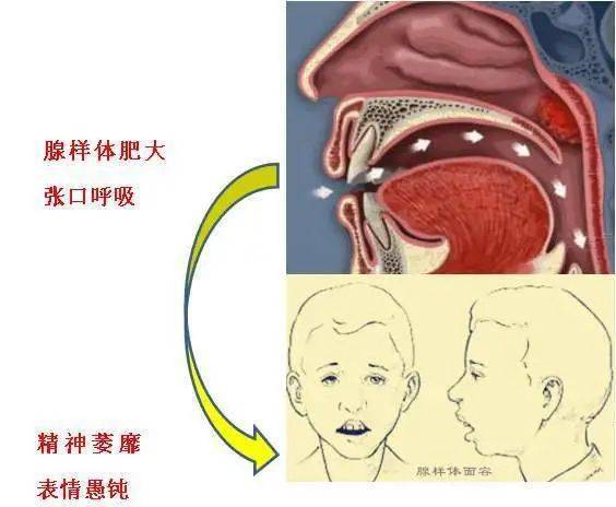 渭南市第二医院耳鼻喉科成功开展腺样体肥大消融术