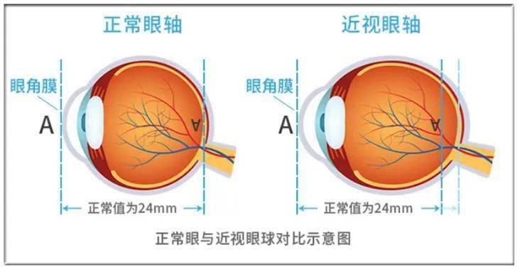 高度近视能跑步吗?跑者用眼应注意什么?