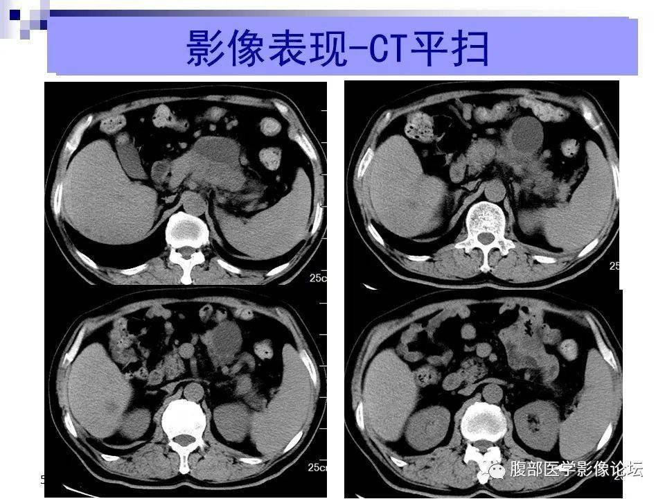 讨论李广明:胰腺体尾部肿块伴胰周囊肿,胰管不扩张,肝内环状强化灶,脾