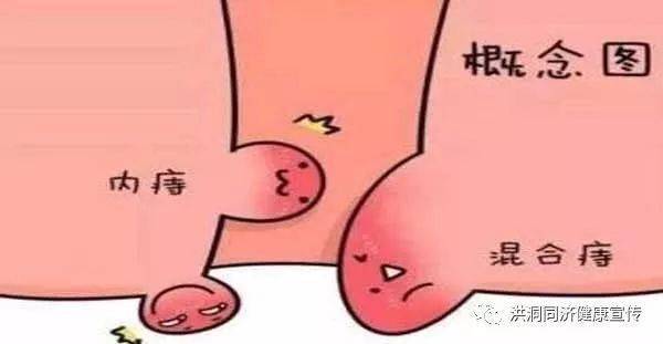 什么是外痔 11bc85e460234810973e374de898fb8c.jpeg
