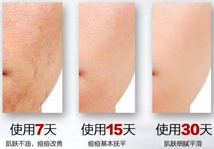 肌肤|脸上挤出的“白浆”是什么？原来是它作怪！出油、过敏也因此而起！