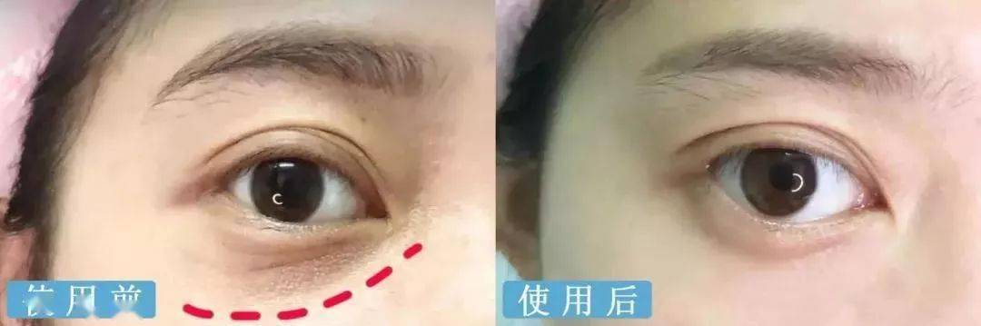 皱纹|抗皱抗衰老还在打针?用它赶走三八脸、鱼尾纹,让小朋友见到你都喊姐姐!