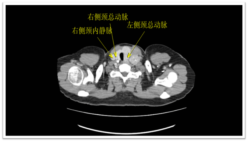 入院后,张女士积极完成了支气管镜,颈部b超,甲状腺b超以及ct增强扫描