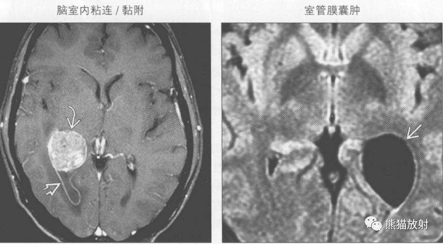 胎儿脑室不对称怎么办