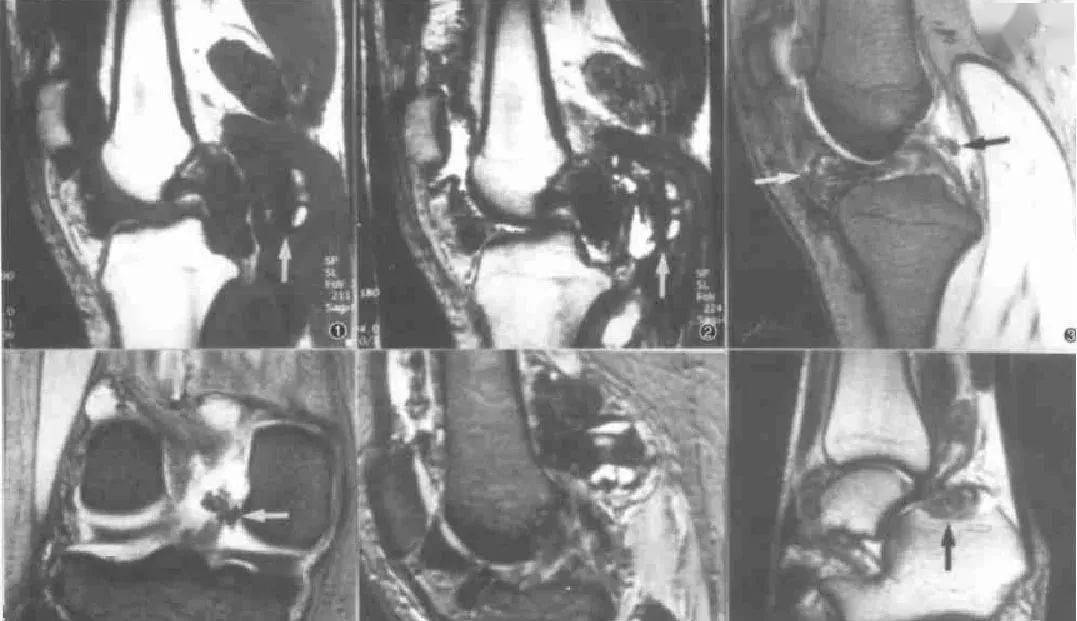 膝盖滑膜炎怎样治疗见效快能彻底 682d1cbfe1b042eaa93910c3663f2b17.jpeg