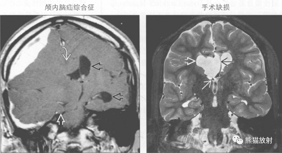 胎儿脑室不对称怎么办