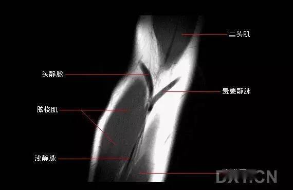 影像解剖 | 肘关节mri图谱,超全整理!_手机搜狐网