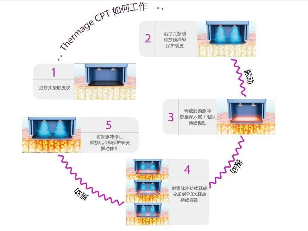 热玛吉什么原理_热玛吉的原理和功效(2)