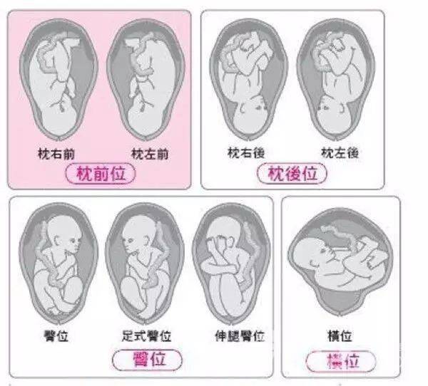 先露(枕前位)的头位是正常的胎位外,其他先露部位如果是宝宝的臀部