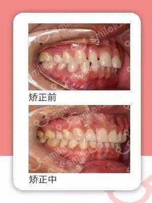 牙齿|“不会吧，不会吧，现在还有没整过牙的明星吧？”