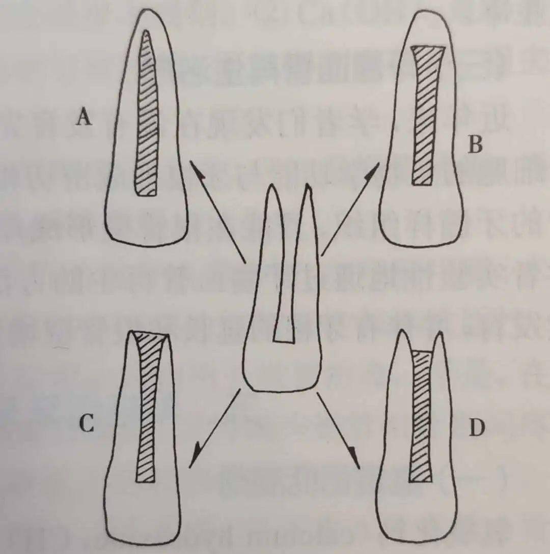 【牙医干货】根尖诱导成形术!