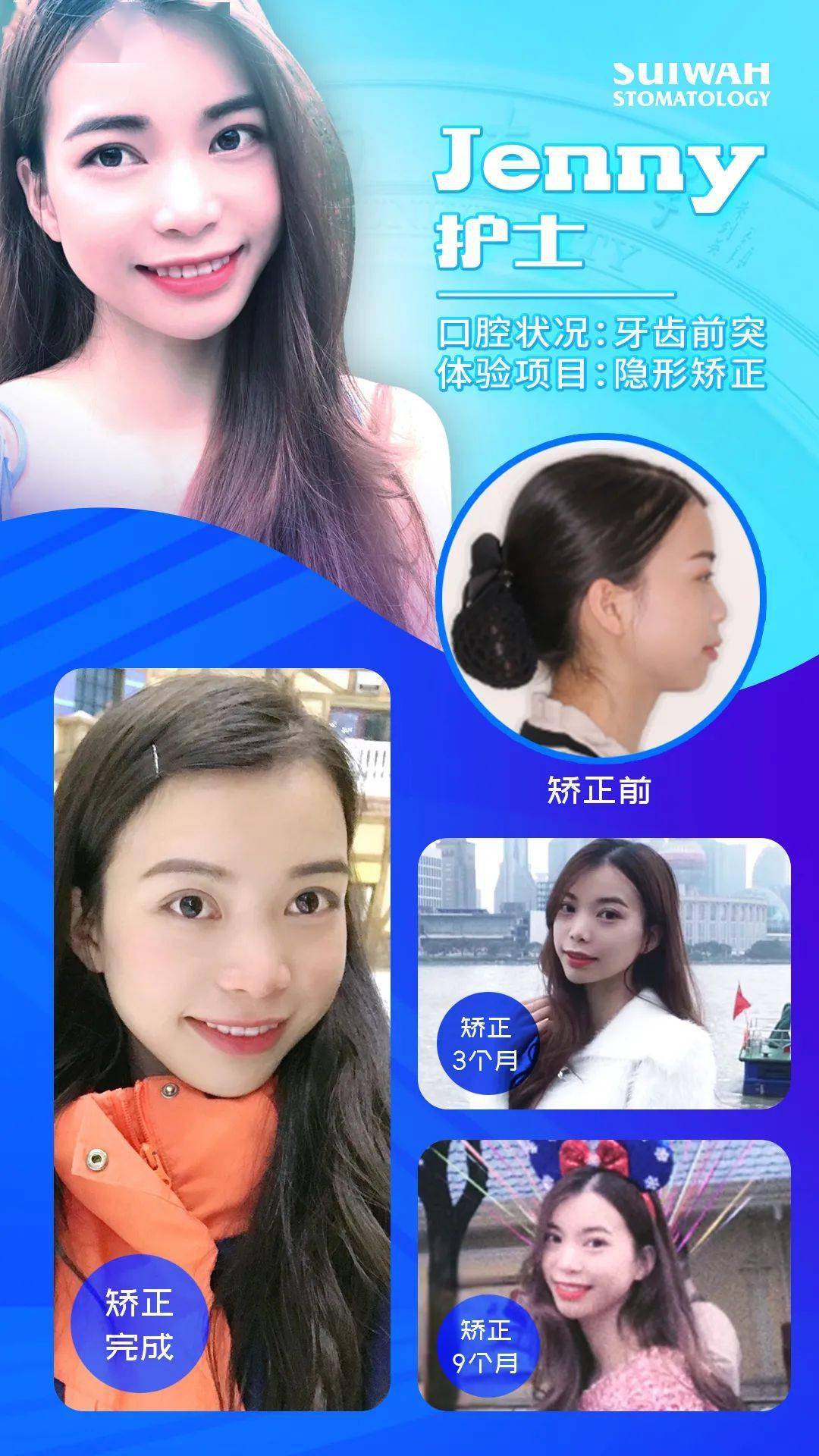 龅牙|广州95后女生从小龅牙，嘴巴都快闭不上！朋友却劝她不要矫牙，一年后......